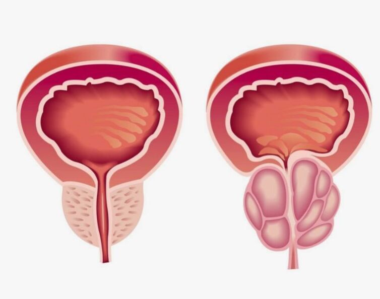 健康和患病的前列腺